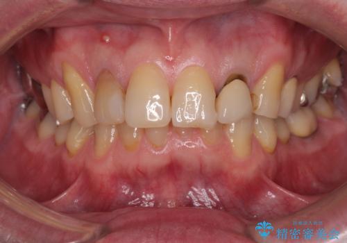 前歯の色味を治したい オールセラミッククラウンの治療前