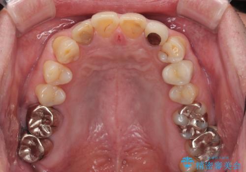 前歯の色味を治したい オールセラミッククラウンの治療前