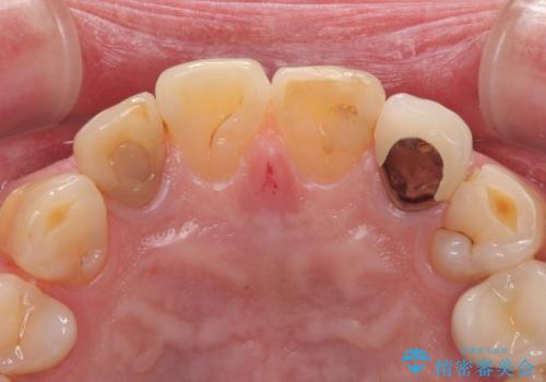 前歯の色味を治したい オールセラミッククラウンの治療前