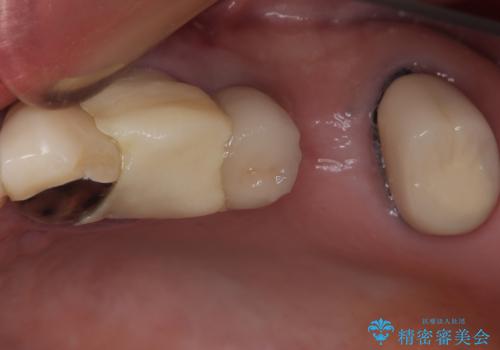 抜歯が必要な歯をインプラントに 短期間インプラント治療