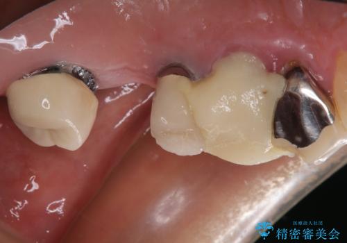 抜歯が必要な歯をインプラントに 短期間インプラント治療の治療前