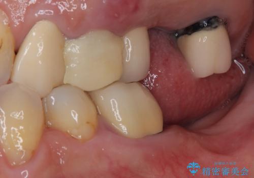 抜歯が必要な歯をインプラントに 短期間インプラント治療の治療前