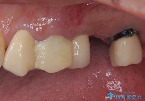抜歯が必要な歯をインプラントに 短期間インプラント治療の治療前