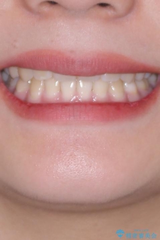 転勤でも安心して治療継続 抜歯スペース閉鎖と深い噛み合わせ改善のワイヤー矯正の治療後(顔貌)