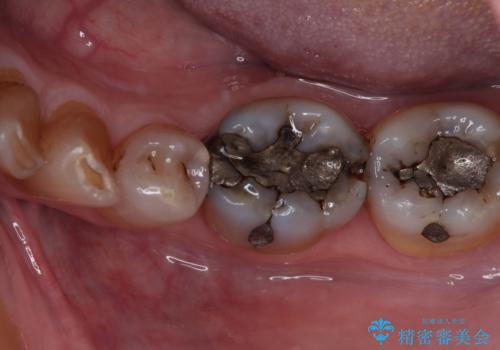 痛くて噛めない オールセラミッククラウンでのむし歯治療の症例 治療前