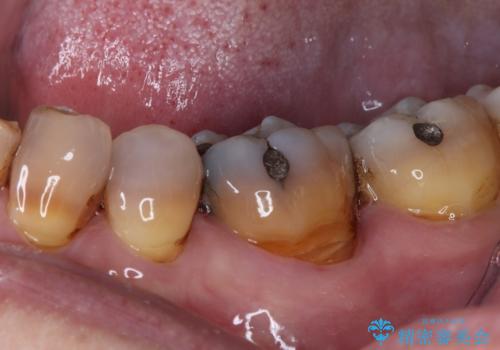痛くて噛めない オールセラミッククラウンでのむし歯治療の治療前