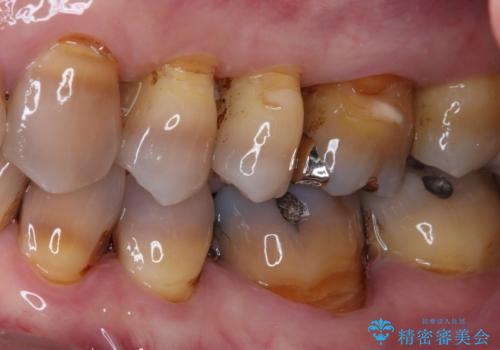痛くて噛めない オールセラミッククラウンでのむし歯治療の治療前