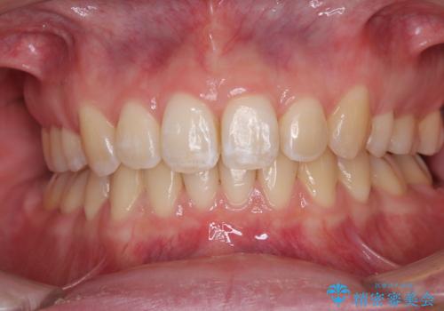 上の前歯が下唇に引っかかる 口元を引っ込めすぎない抜歯矯正治療の症例 治療後