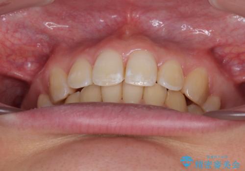 上の前歯が下唇に引っかかる 口元を引っ込めすぎない抜歯矯正治療の治療後