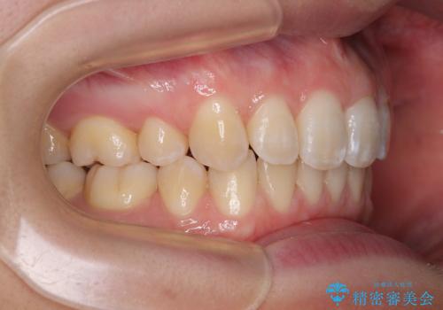上の前歯が下唇に引っかかる 口元を引っ込めすぎない抜歯矯正治療の治療後