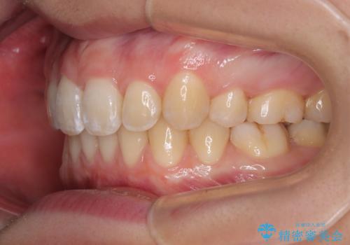 上の前歯が下唇に引っかかる 口元を引っ込めすぎない抜歯矯正治療の治療後