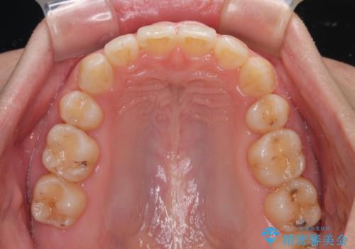 上の前歯が下唇に引っかかる 口元を引っ込めすぎない抜歯矯正治療の治療後