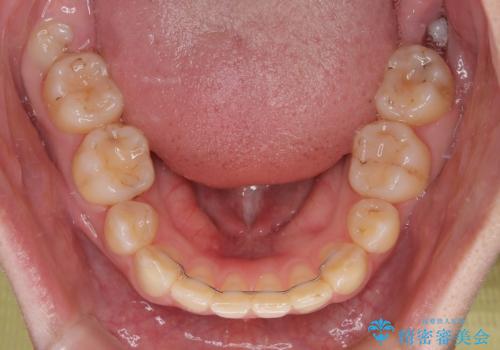 上の前歯が下唇に引っかかる 口元を引っ込めすぎない抜歯矯正治療の治療後