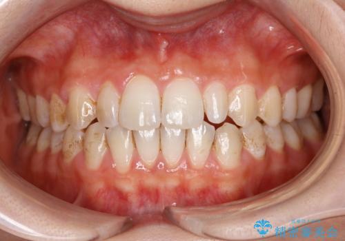 歯を綺麗にしたい!の治療前