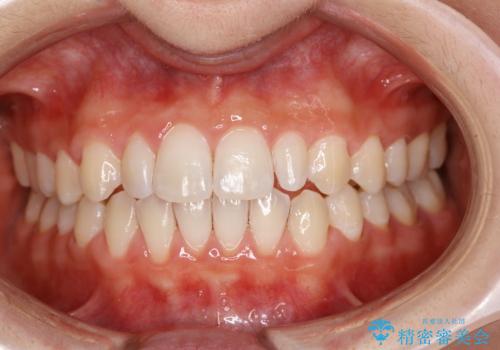 歯を綺麗にしたい!の治療後