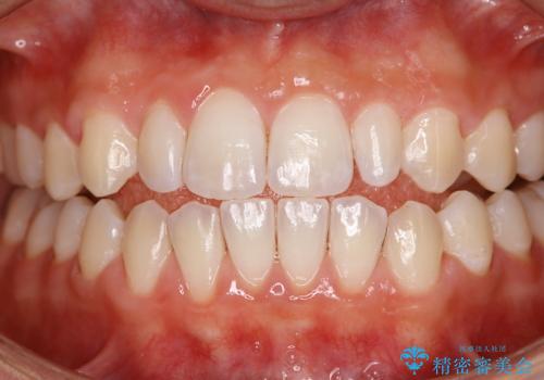 歯を綺麗にしたい!の症例 治療後