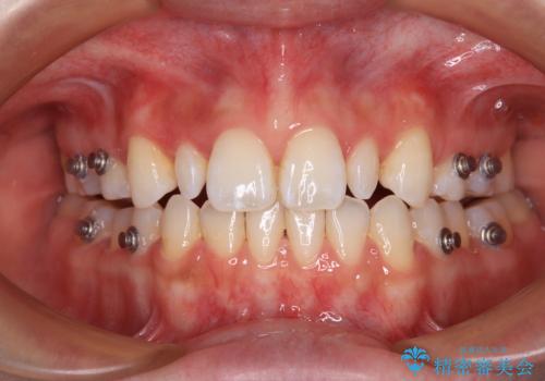 飛び出した前歯 インビザラインを用いた抜歯矯正治療の治療中