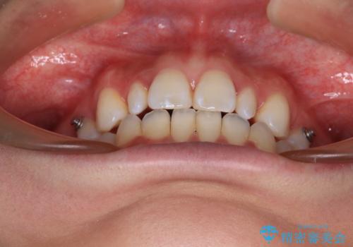 飛び出した前歯 インビザラインを用いた抜歯矯正治療の治療中