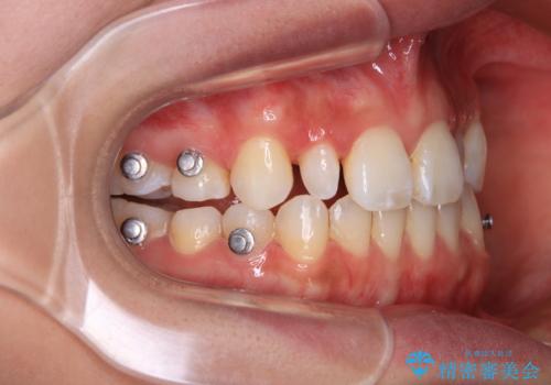 飛び出した前歯 インビザラインを用いた抜歯矯正治療の治療中