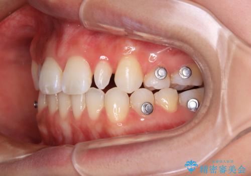 飛び出した前歯 インビザラインを用いた抜歯矯正治療の治療中