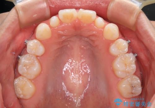 飛び出した前歯 インビザラインを用いた抜歯矯正治療の治療中