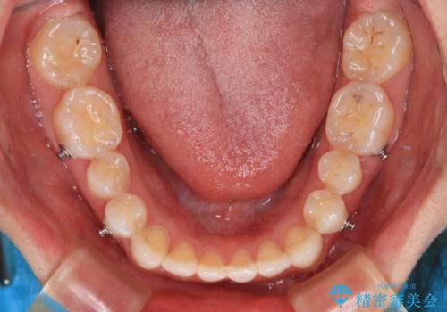 飛び出した前歯 インビザラインを用いた抜歯矯正治療の治療中