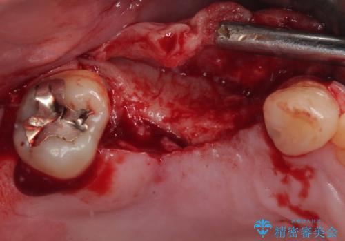 欠損の多い奥歯 インプラントによる補綴治療の治療前