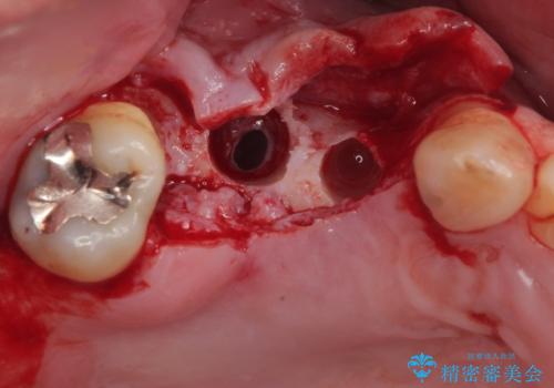 欠損の多い奥歯 インプラントによる補綴治療の治療中