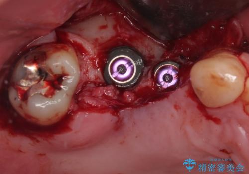 欠損の多い奥歯 インプラントによる補綴治療の治療中