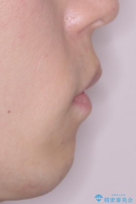 口元の突出感を改善!目立ちにくいワイヤー矯正で自信を持てる自然な横顔にの治療後(顔貌)