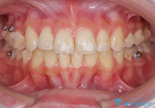 マウスピースで行う出っ歯の改善 後方移動の治療中