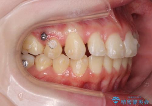 マウスピースで行う出っ歯の改善 後方移動の治療中