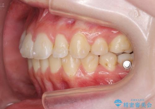 マウスピースで行う出っ歯の改善 後方移動の治療中