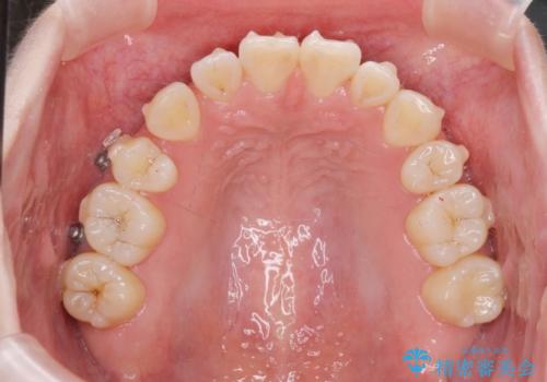 マウスピースで行う出っ歯の改善 後方移動の治療中
