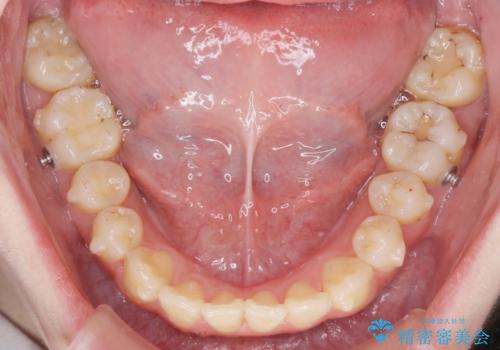 マウスピースで行う出っ歯の改善 後方移動の治療中