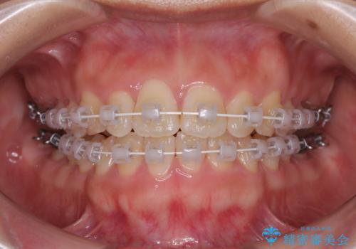 目立ちにくい表側装置で1年完了!狭いアーチを側方拡大し前歯のデコボコを整えた症例の治療中