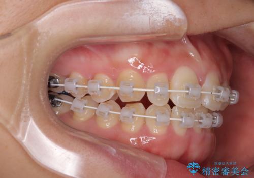 目立ちにくい表側装置で1年完了!狭いアーチを側方拡大し前歯のデコボコを整えた症例の治療中