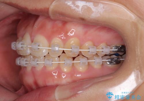 目立ちにくい表側装置で1年完了!狭いアーチを側方拡大し前歯のデコボコを整えた症例の治療中