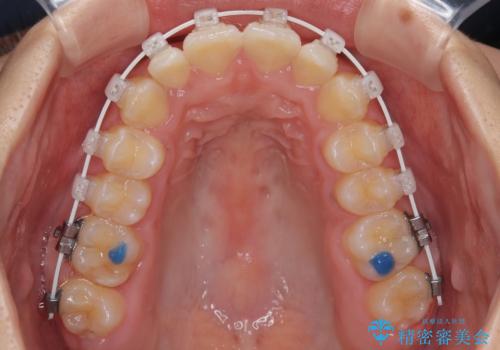 目立ちにくい表側装置で1年完了!狭いアーチを側方拡大し前歯のデコボコを整えた症例の治療中