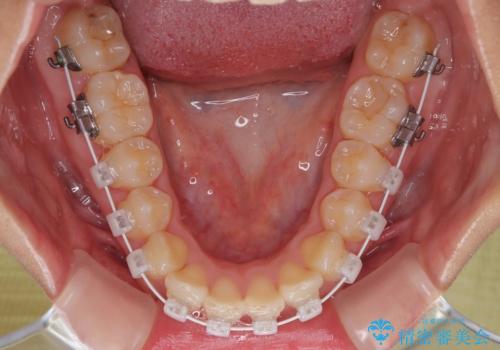 目立ちにくい表側装置で1年完了!狭いアーチを側方拡大し前歯のデコボコを整えた症例の治療中