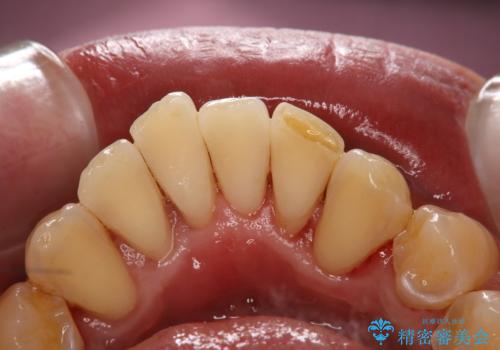 歯石除去で舌触りの変化の症例 治療後