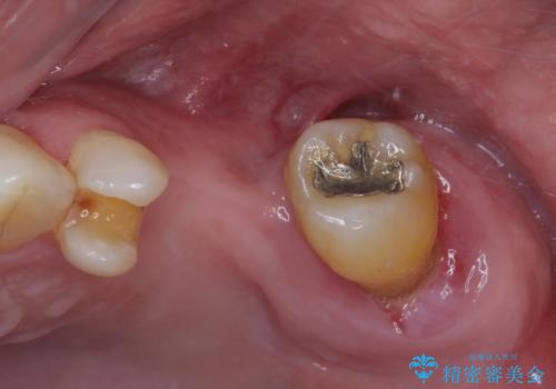 欠損の多い奥歯 インプラントによる補綴治療の治療前
