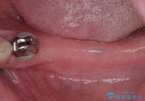 欠損の多い奥歯 インプラントによる補綴治療の治療前