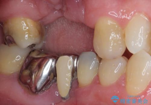 欠損の多い奥歯 インプラントによる補綴治療の治療前