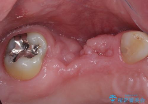 欠損の多い奥歯 インプラントによる補綴治療の治療前