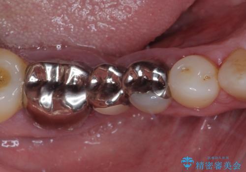 欠損の多い奥歯 インプラントによる補綴治療の治療前
