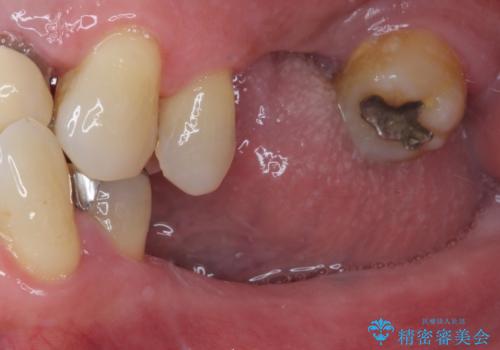 欠損の多い奥歯 インプラントによる補綴治療の症例 治療前