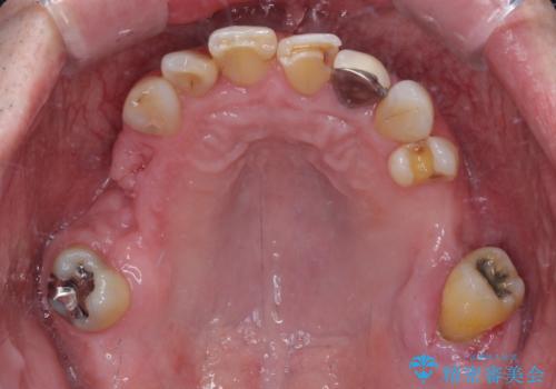 欠損の多い奥歯 インプラントによる補綴治療の治療前