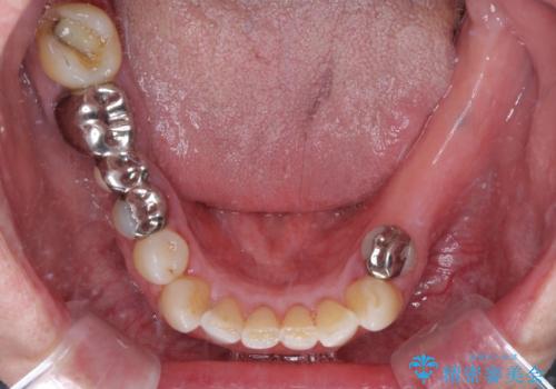欠損の多い奥歯 インプラントによる補綴治療の治療前