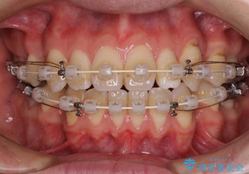 口元の突出感を改善!目立ちにくいワイヤー矯正で自信を持てる自然な横顔にの治療中